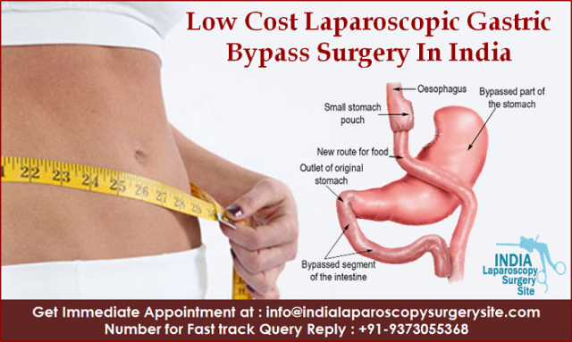 Low cost laparoscopic gastric bypass surgery backed with quality sums up Indian Healthcare Services